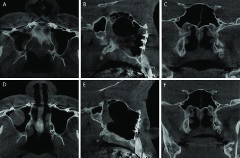 Healing pattern of the intentional fracture site of the pterygoid ...