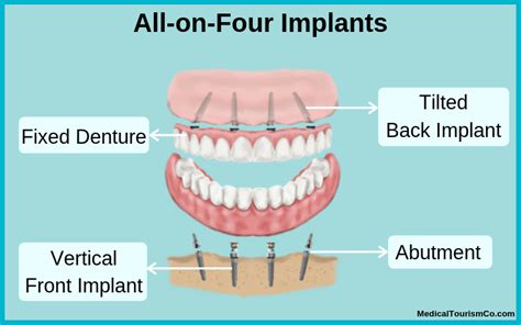 All-On-4 Dentures - Stubbs Family Dentistry