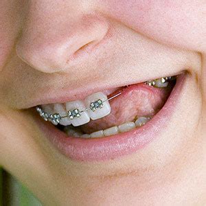 Removing One or More Teeth Could Improve Orthodontic Outcomes