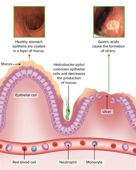 Small Intestine Ulcer Treatment