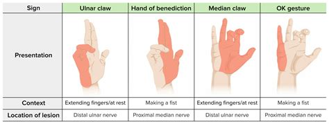 Median Nerve Injury