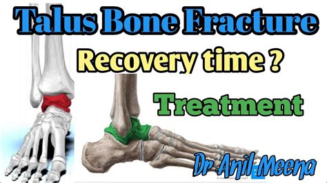 talus bone fracture recovery time | talus bone fracture treatment ...