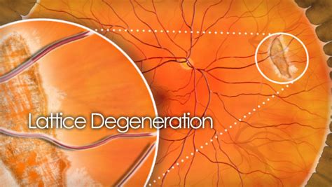 Lattice degeneration causes, treatments and surgery