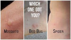 8 Differences Between Bed Bug Bites and Spider Bites with Table - Core ...