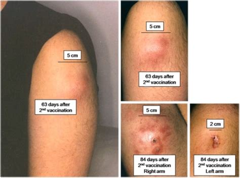 Case report of local reaction and sterile abscess forma | Open-i