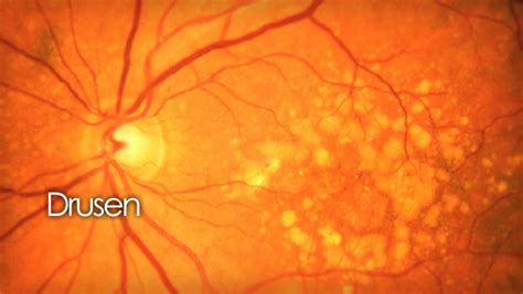 Drusen | small deposits in the retina from macular degeneration