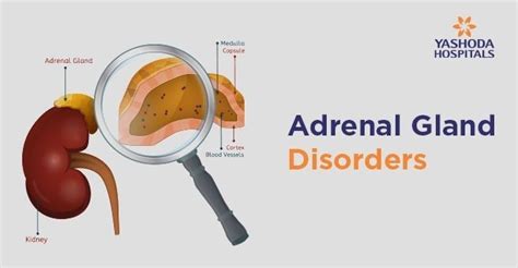 Adrenal Gland Disorders: Types, Causes, Symptoms, Diagnosis, Treatment ...