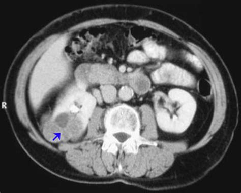 Image: Renal Cell Carcinoma (Contrast CT Scan) - MSD Manual ...