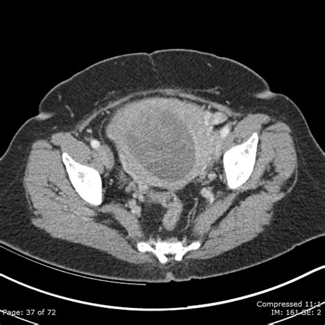 Uterine leiomyosarcoma | Image | Radiopaedia.org