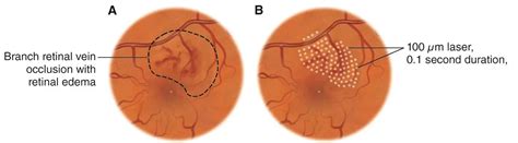 Laser photocoagulation - American Academy of Ophthalmology