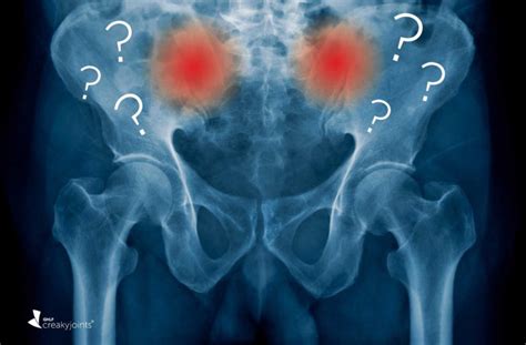 The Progression of Non-Radiographic Axial Spondyloarthritis