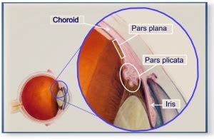 pars planitis - Uveitis.org | OIUF