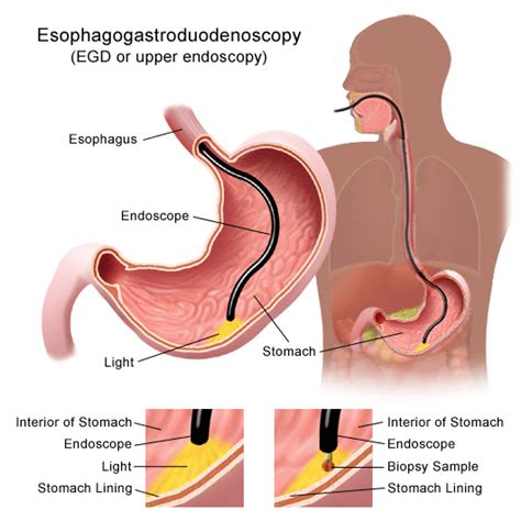 EGD (Esophagogastroduodenoscopy) - Family Medical Center of Hastings