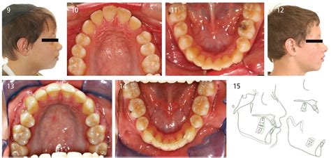 Orthodontic Extraction Therapy: A Hard Look At the Evidence - Decisions ...