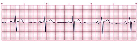 UNC MEDIA | Heart Rhythms