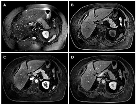 Magnetic resonance imaging of pancreatitis: An update