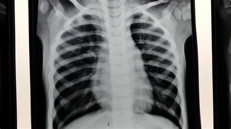 Hyperinflated Chest X Ray