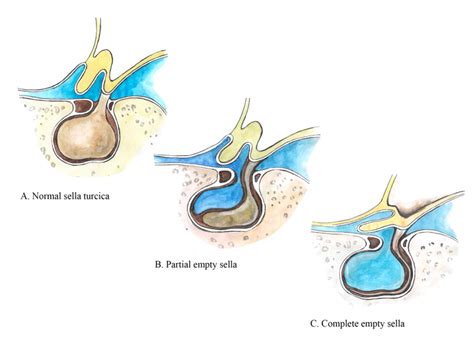 Hecho para recordar reunirse Roble empty sella syndrome symptoms ...