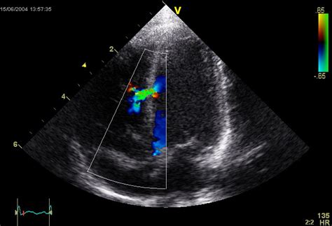 File:Ventricular Septal Defect.jpg - Wikipedia