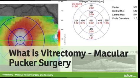 Vitrectomy - Macular Pucker Surgery and Recovery - YouTube