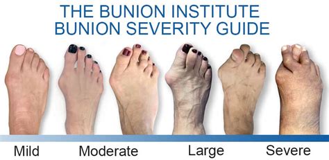 Which Bunion Treatment is Best for You? - The Bunion Institute