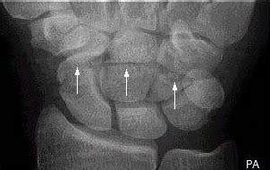 Capitate fracture