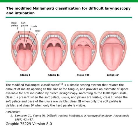 Modified mallampati classification – Artofit