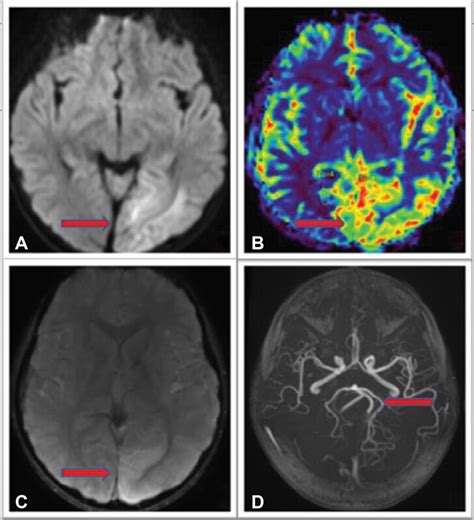 Restricted diffusion on diffusion-weighted imaging ( ), increased ...