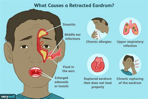 Retracted Ear Drum Causes, Symptoms, and Treatment