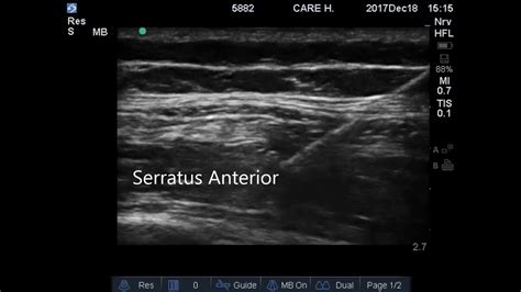 Ultrasound Guided Serratus Anterior Block