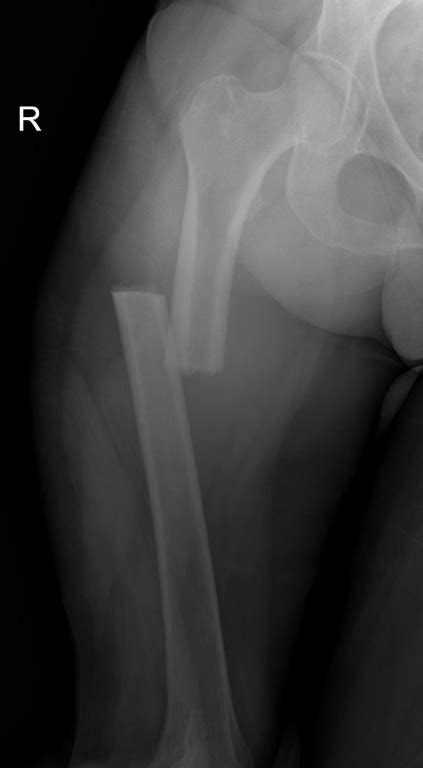 bilateral femur fractures | pacs