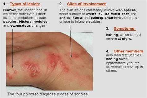 14 Effective Home Remedies Against Scabies