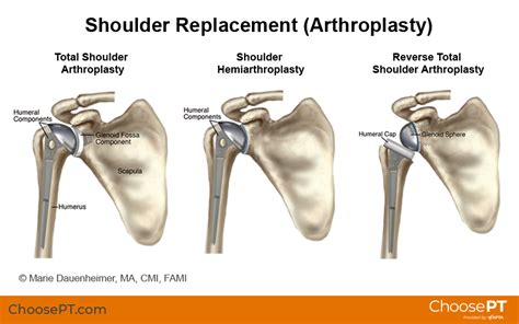 What to Expect With Shoulder Replacement Surgery