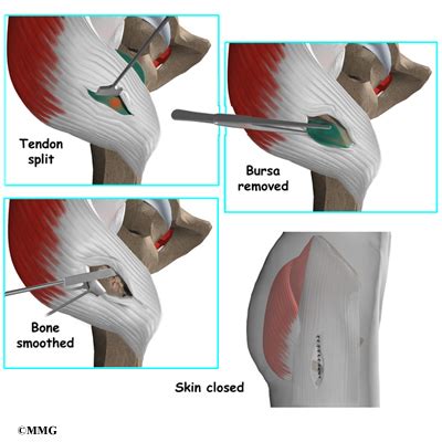 Trochanteric Bursitis (Greater Trochanteric Pain Syndrome) - Morphopedics