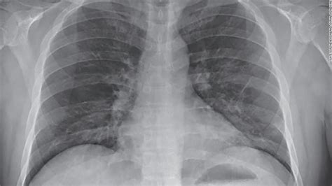 Symptoms Of Lung Infection