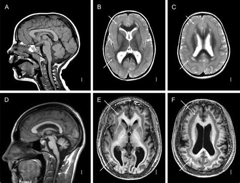 Lissencephaly & lissencephaly type 1 causes & lissencephaly life expectancy