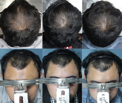 Minoxidil Before And After: Photos & Results | Wimpole Clinic