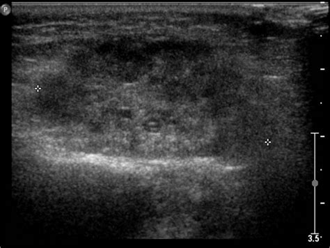 parotitis - Pediatric Imaging