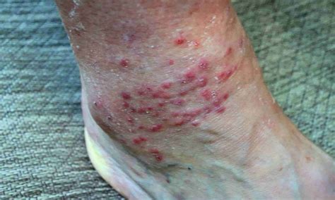 How to Get Rid of Chiggers? How to Treat Chigger Bites?