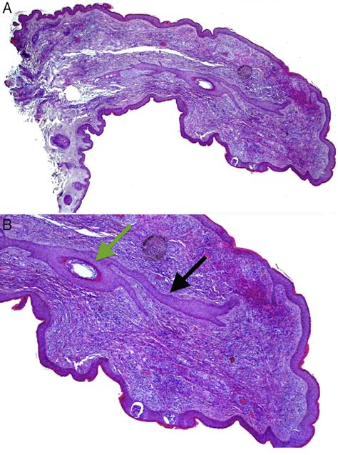 (A) Histopathology of the papule located on the columella. Hematoxylin ...