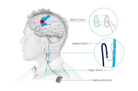 Vagus Nerve Stimulation Side Effects