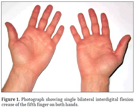 Single bilateral interdigital flexion crease of the fifth finger in a ...