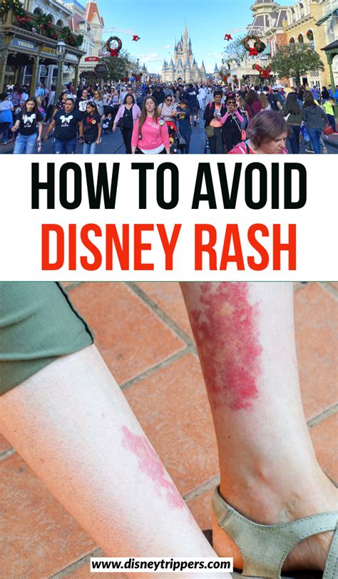 Disney rash – Artofit