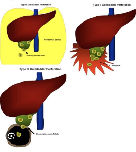 Gallbladder Perforation: Causes, Treatment, and Prevention - Dr ...