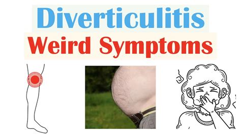 Weird Symptoms of Diverticulitis | Atypical Clinical Features of ...