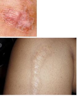 Treatment and Solution for Scars