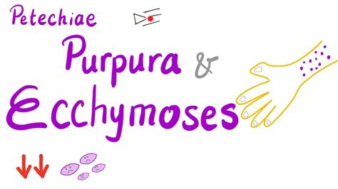 Ecchymosis Vs Petechiae