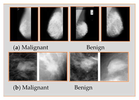 Applied Sciences | Free Full-Text | Breast Cancer Detection Using ...