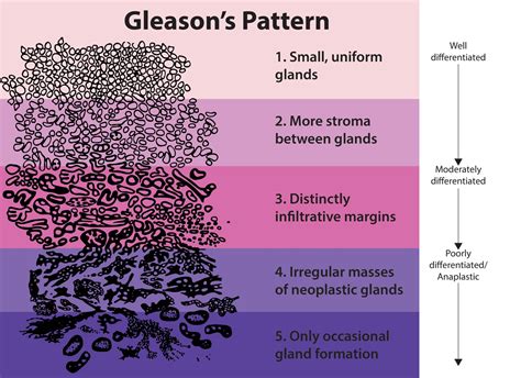 The Basics of Tumor Grading and Cancer Staging | BioChain Institute Inc.