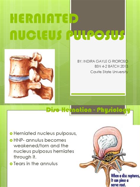 HERNIATED NUCLEUS PULPOSUS.pptx | Animal Anatomy | Musculoskeletal System